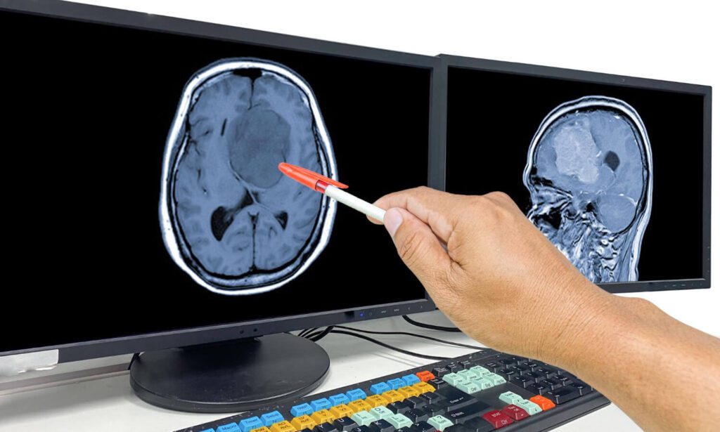 Ia E O Diagnóstico De Tumor Cerebral