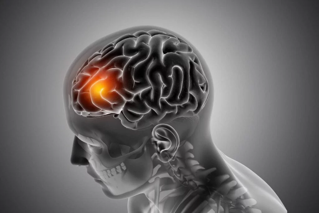 Dr. Sérgio Adrian Fernandes Dantas - Neurocirurgia - Fatores Cruciais Para A Recuperação Após Um Avc Avc