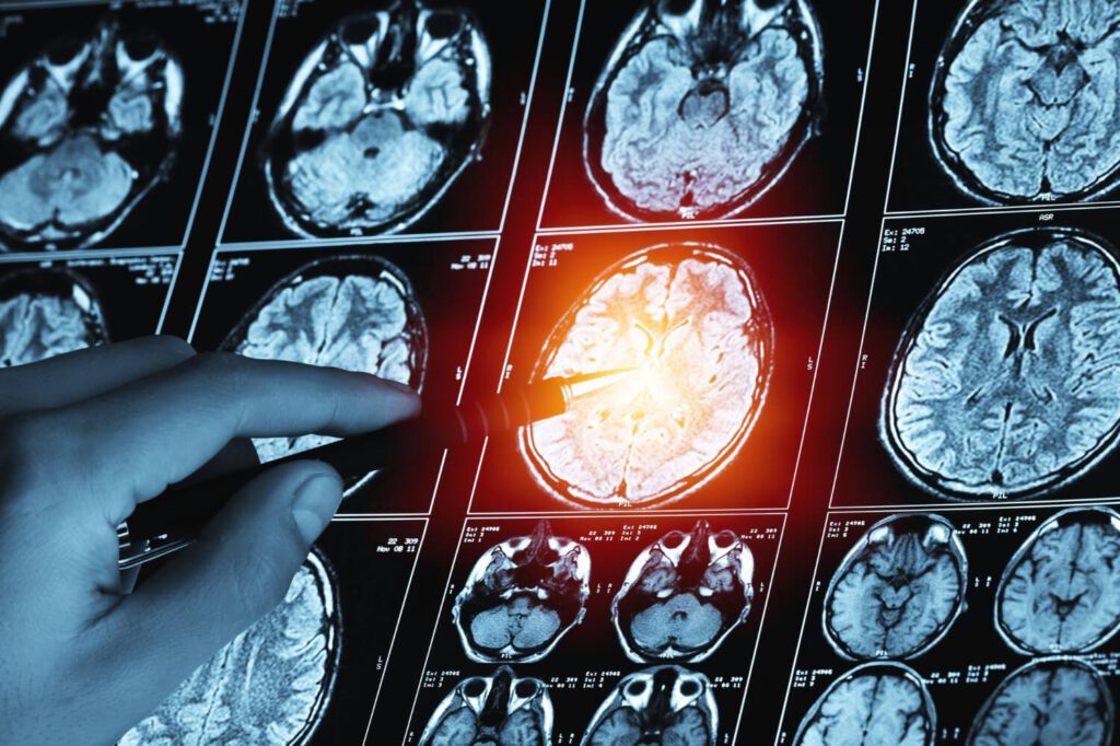 Tumor Cerebral: Quando Desconfiar?