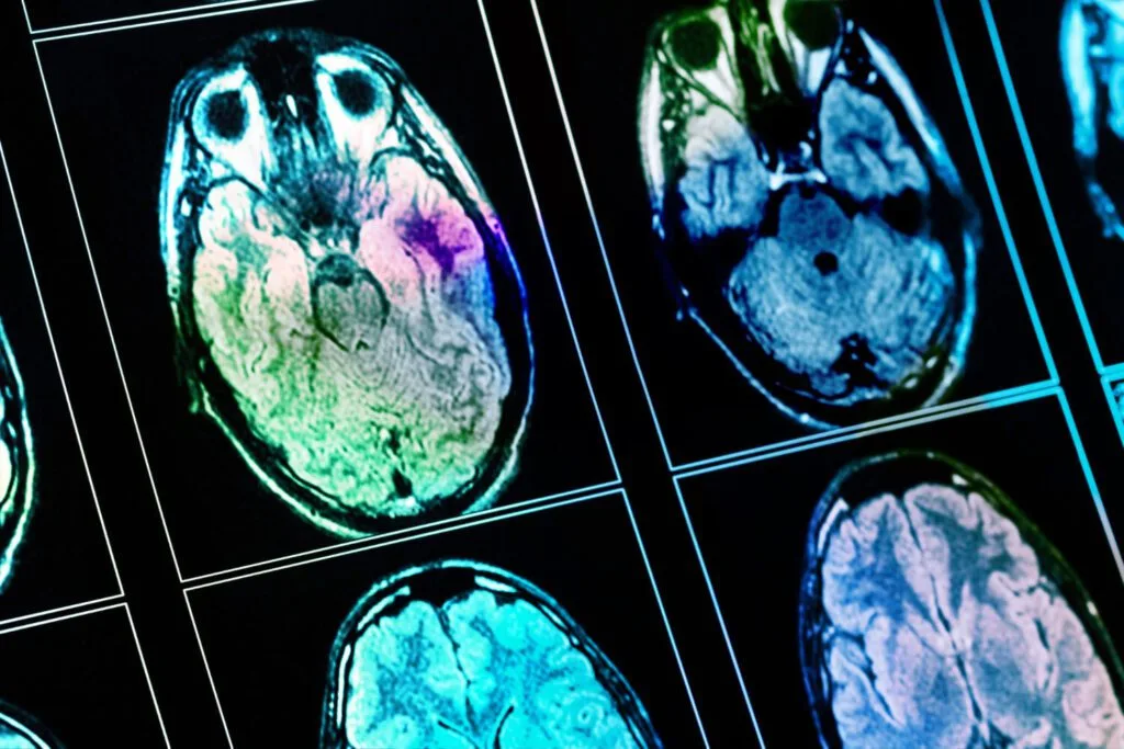 Dr. Sérgio Adrian Fernandes Dantas - Neurocirurgia - Imagens Cerebrais Acabam De Ficar 64 Milhões De Vezes Mais Nítidas Imagens Cerebrais