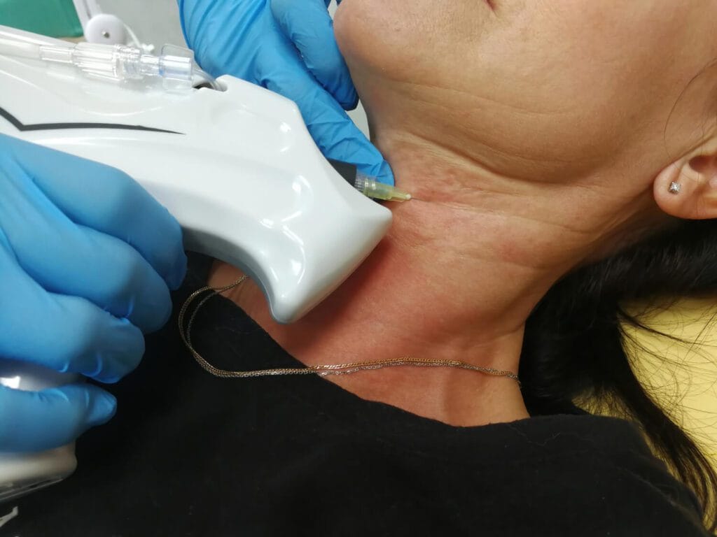 Procedimentos Neurocirúrgicos Modernos Para Dor Crônica No Pescoço